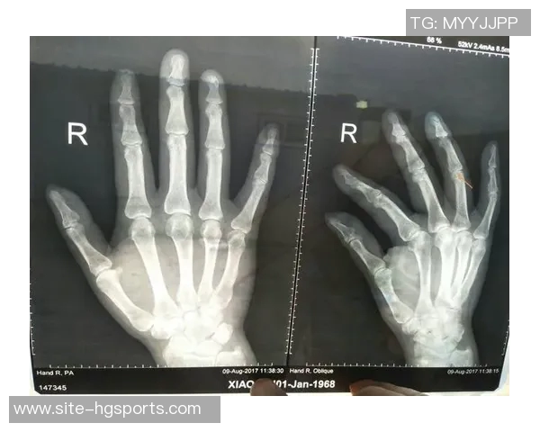 森林狼球员莱昂纳德米勒右手小拇指受伤两周后将进行复查